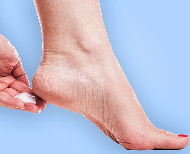 Have Cracked Heels? These 9 Home Remedies Will Solve Your Problem!