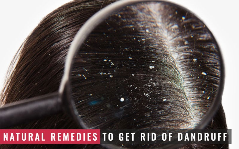 9 Home Remedies to Get Rid of Dandruff Naturally